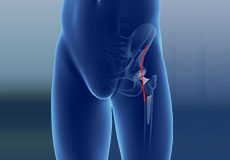 Direct Anterior Hip Replacement
